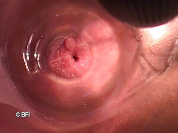 Pegging insertion