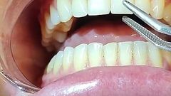 Complete Teeth Exam by the Dentist, Installation of Jewelry