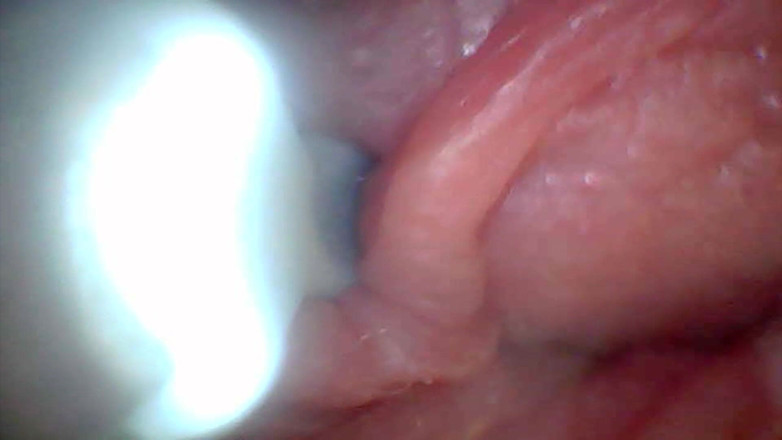 Twittiy: La videocamera endoscopica mostra le parti più sensibili del pene...