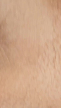 Pembuluh dilator yang luar biasa memiliki peningkatan yang tidak proporsional.