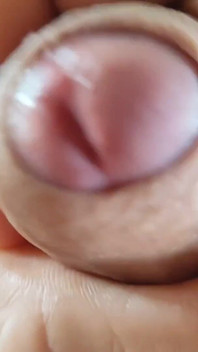Opening the Scar of the Rough Frenulum!