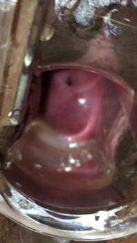 Cum Cervix Insemination
