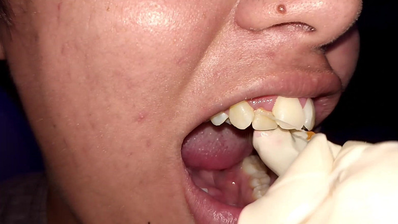 Elimoon: Versuche, Zahnseide zu verwenden (Nahaufnahme)