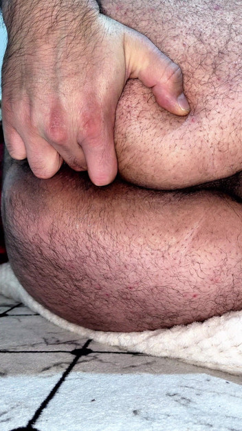 Danilol: Anal spermalek