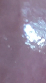 Dilation of the Glans Eye Has a Pleasant Surprise.