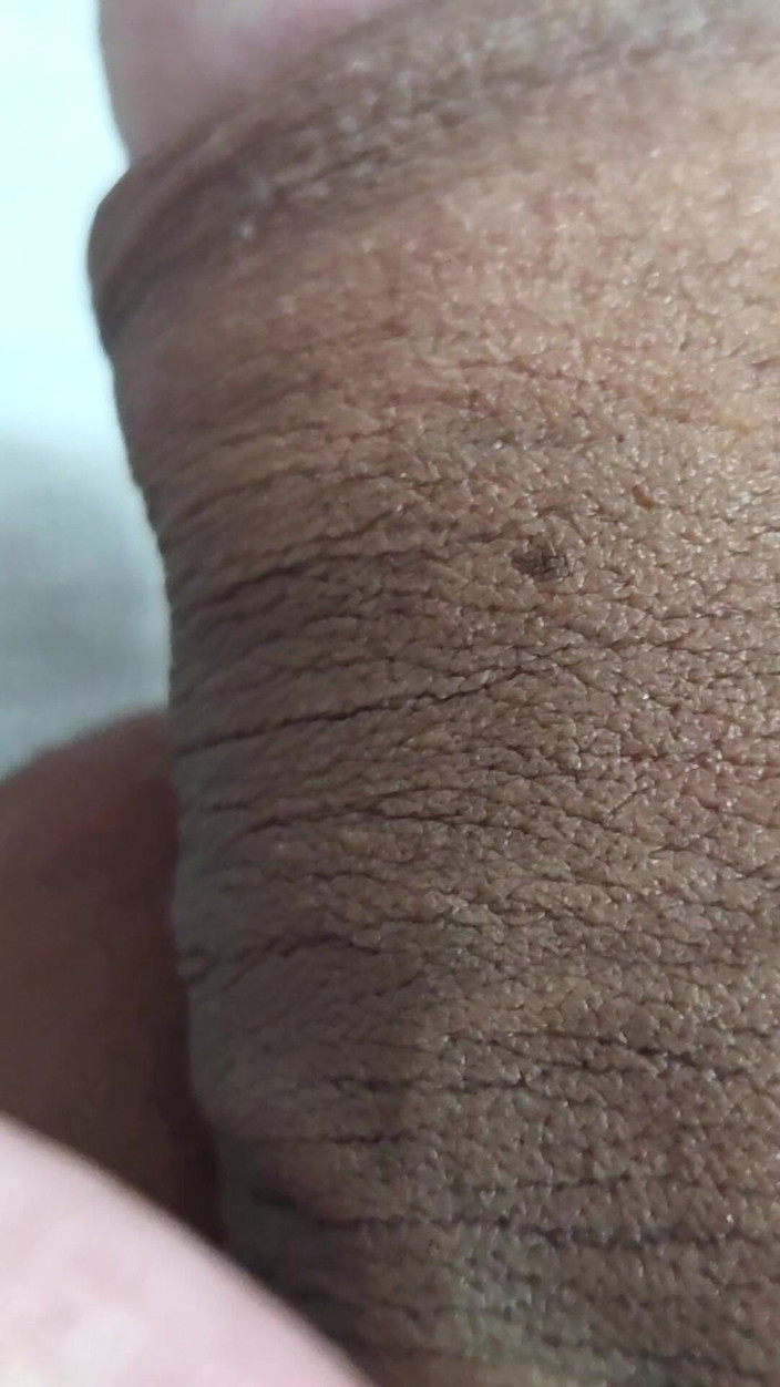 Lkdick8: What Is That on My Penis