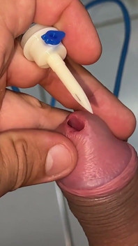 Sounding Extreme Sharp Probing in the Urethral Canal.