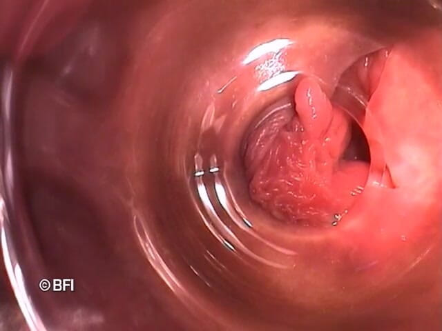 Pegging insertion: Dosare ciudate 162