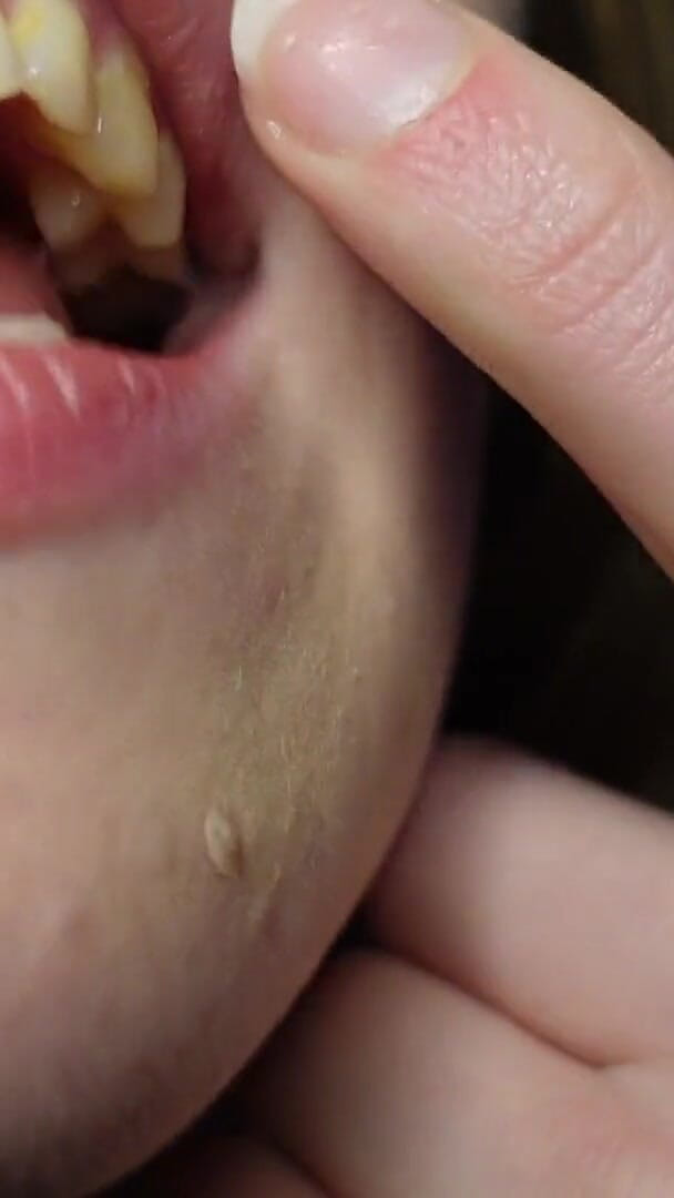 HotRedWildcat: I Tell You About the Fillings in My Teeth and...