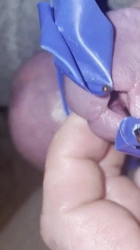 Insertion de méat urinaire à la cire de bougie