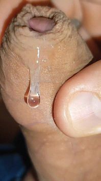 Difficult Fluid Control Due to Straight Phimosis.