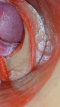 Ženské Inseminace - Vnitřní Kamera Zachycuje Hlubokou Mužskou Obrovskou Ejakulaci