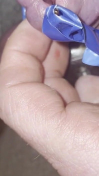Insertion de méat urinaire à la cire de bougie