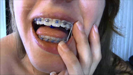 Princess Leia: Embracing Braces
