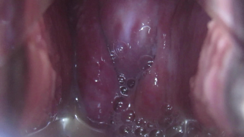 VeeVee Vixen: Inseminación en el cuello uterino
