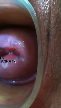 Đây là những gì cổ tử cung của tôi trông giống như sau một năm mà không nhìn thấy nó