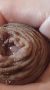 Great Phimosis Getting in the Way of the Boy's Orgasm