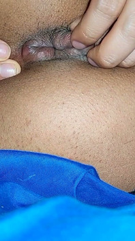 후장 치질