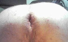 Hậu môn điều trị lỗ hậu của tôi