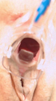 Gyno Fetisch Söker Livmoderhalsen - Vidöppnad Fitta Med Gyno Spegel
