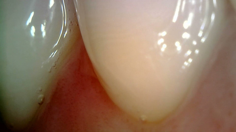 Nicoletta Embassi: Medical Endoscope Oral Exam: Gummy Chewing, Extreme Teeth &amp; Tongue Macro