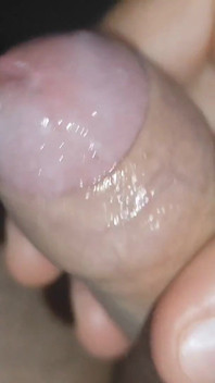 I Have the Largest Ejaculating Phimosis in the World!!