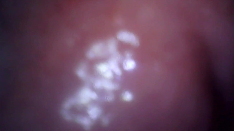 Marcus Pollack: Pemeriksaan anal klinik mesum ekstrem oleh dua perawat