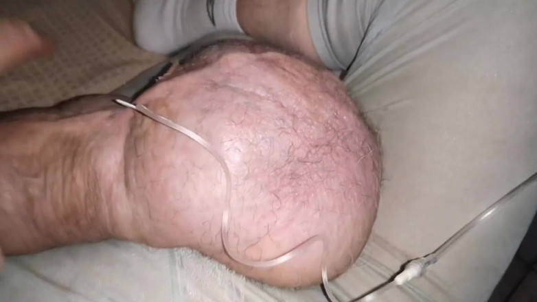Monster_Meat_: Dva litry glukózy uvnitř mého 1380cc silikonu