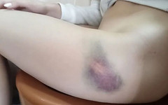 MargoAlisa: Margot撒尿，腿上有一块很大的淤青