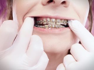 Arya Grander: ASMR: upgraded braces with chain-link rubber bands and nitrile gloves (Arya...