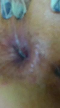 Anal Selbst Fisting