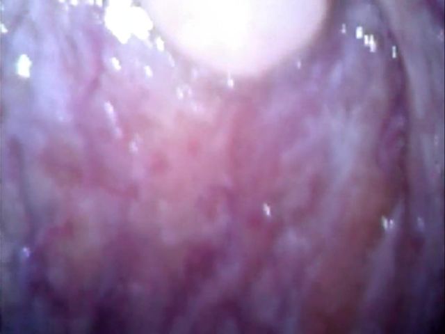 POV with Endoscope (Idmir Sugary)