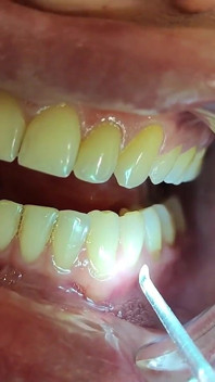 Complete Teeth Exam by the Dentist, Installation of Jewelry