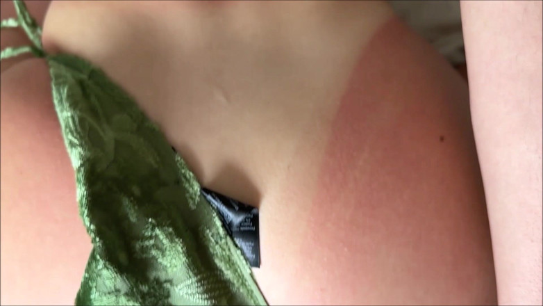 Alex Adams: Accidentul arsurilor solare ale surorii vitrege - Arabella Rose - terapie de...