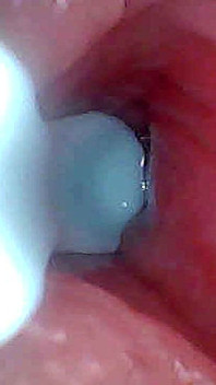 Jag Kunde Inte Tro Vad Som Händer Inuti Penis När Spermier Passerar (endoskopisk Film)