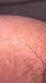 Macro Skin on My Dick
