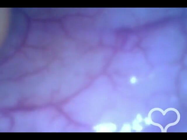 Lina Free: Endoscopio anal hasta el camino en mi colon transverso!