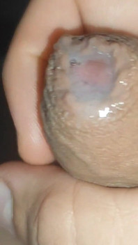 I Have the Largest Ejaculating Phimosis in the World!!