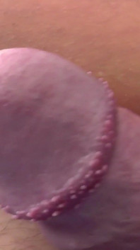 Tayson's glands or pearly papules