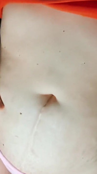 Sẹo sinh mổ 22 năm