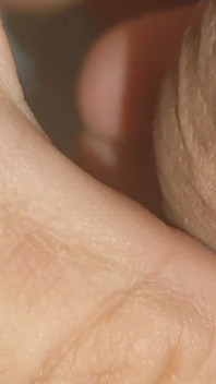 Large Healed Phimosis Holds the Cock Head.
