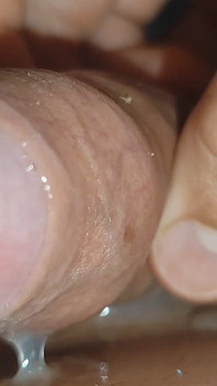 Large Cheese Accumulated in Close up of Glans