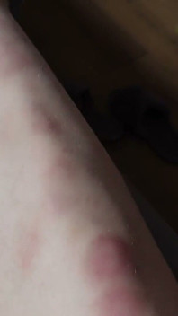 Je Te Montre Les Bleus Sur Mes Jambes Après Une Baise
