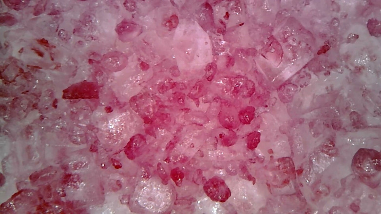 Nicoletta Embassi: Pemeriksaan Oral Endoskop Perubatan: Gummy Chewing, Gigi melampau &amp; Macro lidah