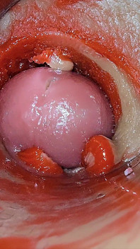 Cámara Dentro Del Coño Profundo Captura Sobredosis De Eyaculación De Esperma - Asmr