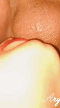 sampai dicrot di wajah dan bibir