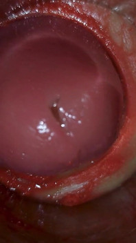 Camera Inside Deep Pussy Captures Huge Ejaculation of Sperm Asmr
