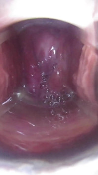 Inseminação do colo do útero