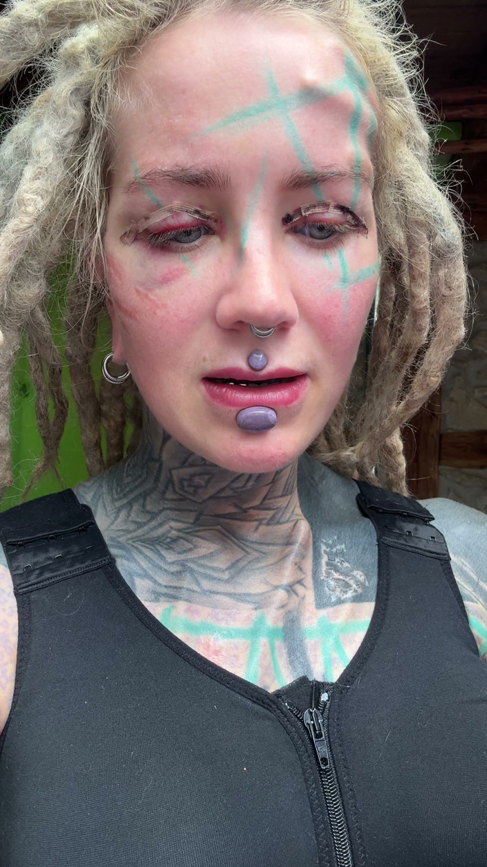 Anuskatzz: This Is Day 4 After My Boobs Surgery and My Body...