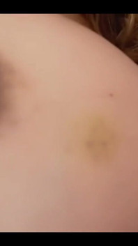Bruise on Tits Update